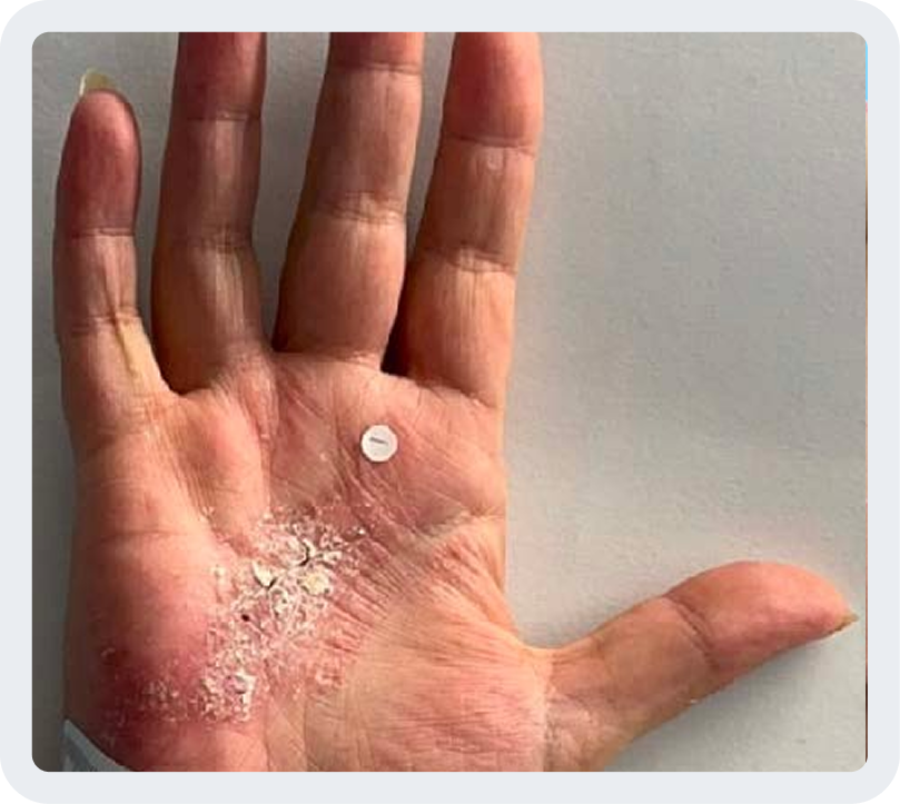 Hand/foot PsO at Week 0