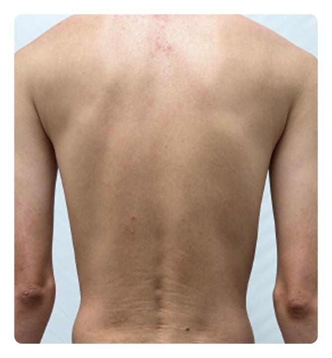 Clearer skin with ICOTYDE at Week 16 in IGA 0; PASI 100 ADVANCE 2