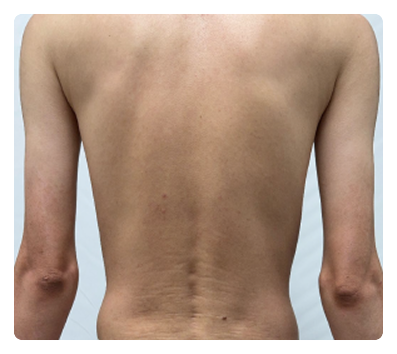 Clearer skin with ICOTYDE at Week 16 in IGA 0; PASI 100 ADVANCE 2