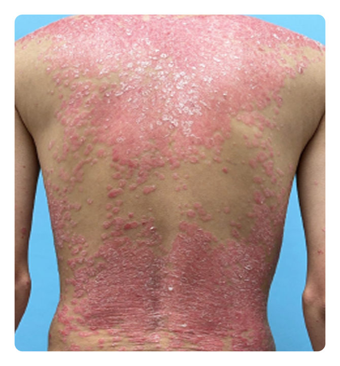 Patient photo at Week 0 in IGA 0; PASI 100 ADVANCE 2