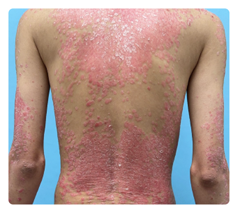 Patient photo at Week 0 in IGA 0; PASI 100 ADVANCE 2