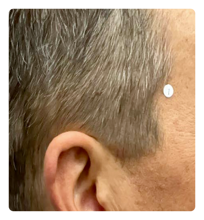 Scalp PsO at Week 16 showing completely clear skin