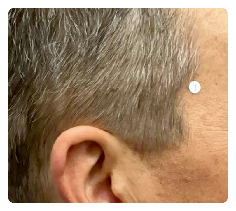 Scalp PsO at Week 16 showing completely clear skin