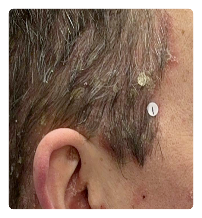 Scalp PsO at Week 0