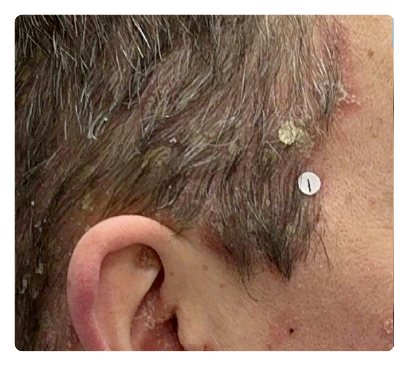 Scalp PsO at Week 0